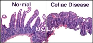 Celiac_disease