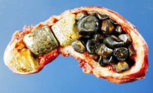 Gallstones