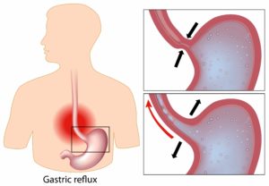 Indigestion-scaled