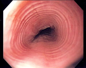 Multi_ring_esophagus