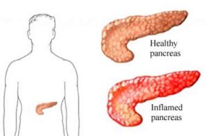 Acute_pancreatitis