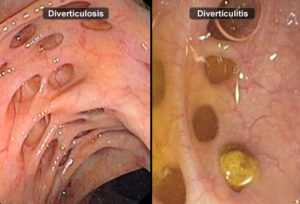 Diverticulitis