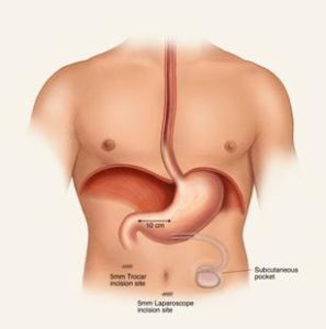 Gastroparesis