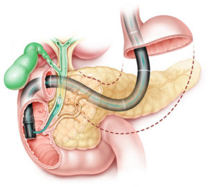 Ercp