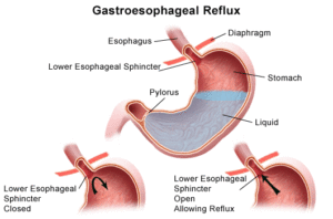 Gastroesophageal-reflux-disease-gerd