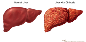 Liver_cirrhosis