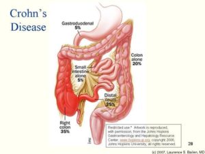 Crohns-disease