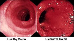 Ulcerative-colitis