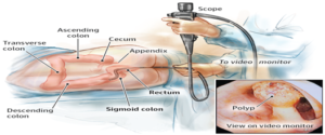 Colonoscopy-screening-for-colon-cancer.-when-should-you-get-checked-2